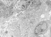#thelancetoncology #sarcome #nivolumab #ipilimumab Nivolumab avec sans ipilimumab pour traitement sarcome métastastique (Alliance A091401) deux essais phase randomisés comparatifs