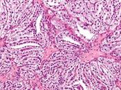 #thelancetoncology #carcinomerénal #avelumab #axitinib Résultats préliminaires pour avelumab axitinib comme traitement première ligne chez patients atteints carcinome cellules claires rein (JAVELIN Renal 100) essai ouvert phase 1b...