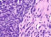 #thelancetoncology #CBNPC #durvalumab Durvalumab comme traitement troisième ligne postérieur pour cancer poumon petites cellules (ATLANTIC) étude ouverte simple bras phase