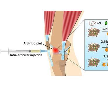Un hydrogel révolutionnaire pour gérer les poussées de l’arthrite inflammatoire