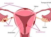 Endométriose attention tabou