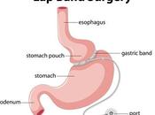 DIABÈTE L’anneau gastrique aussi efficace metformine