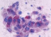 CANCER FOIE L’espoir d’une immunothérapie radicale