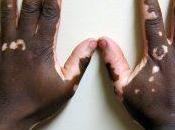 vitiligo