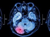 ÉPILEPSIE Eliminer nouveaux neurones induits crise