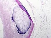 ATHÉROSCLÉROSE particules ossifiées retrouvées dans sang