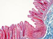 COLITE ULCÉREUSE médicament polyarthrite réduit perméabilité intestinale