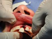 choses savoir avant d’avoir recours implants dentaires