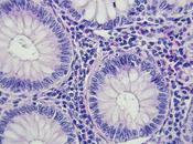 CANCER COLORECTAL Pourquoi frappe avant