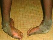 Cameroun traitement pied protocole d’accord signé entre Minsante