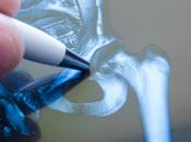 PROTHÈSES OSSEUSES substance ostéoprotectrice pourrait changer donne