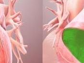 CHIRURGIE L'hydrogel protège adhérences post-opératoires