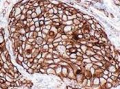 #thelancet #cancerdupoumon #atezolizumab Atezolizumab adjuvant après chimiothérapie adjuvante dans cancer poumon petites cellules réséqué stade IB-IIIA (IMpower010) essai phase randomisé, multicentrique, ouvert