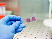 CANCER FOIE biopsie optique secours diagnostic