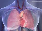 VIH, risque crise cardiaque très augmenté avec l’âge
