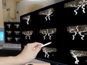 THROMBOSE VEINEUSE CÉRÉBRALE vortex dissout caillot minutes