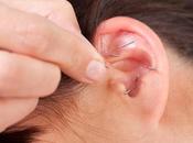 OBÉSITÉ L’acupuncture auriculaire pour perdre poids